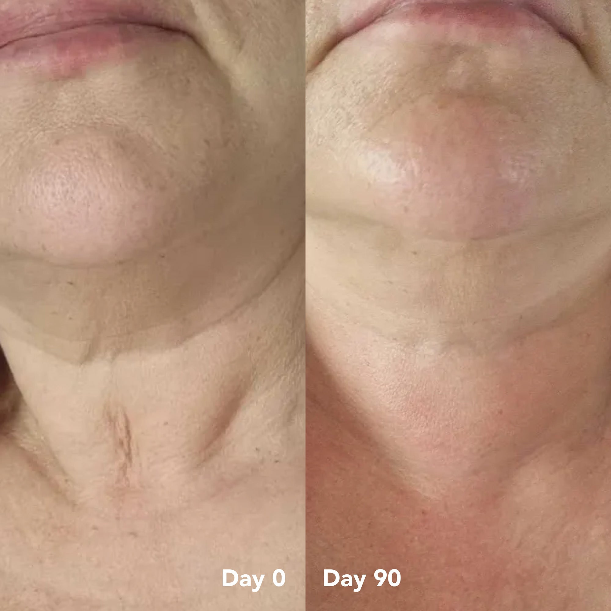 Mel before and after